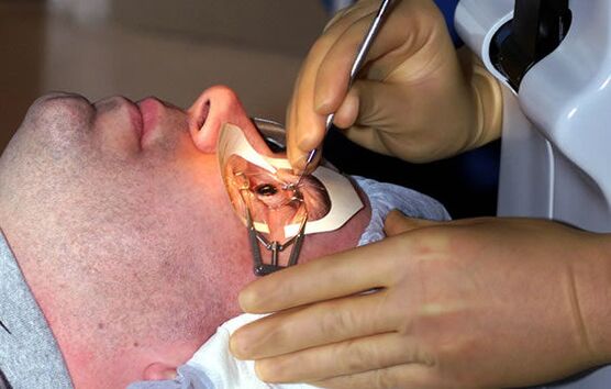 Scleroplastica per miopia per stabilizzare la vista